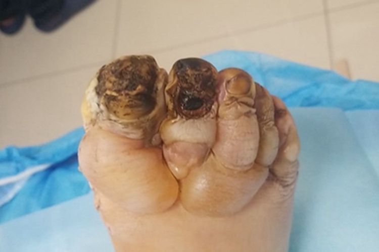 高压电烧伤脚趾皮肤发黑图 高压电烧伤脚趾皮肤发黑图