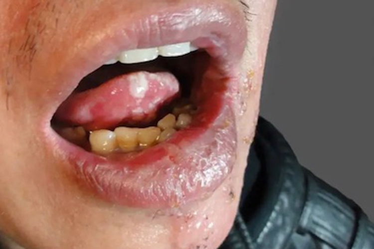 口腔带状疱疹嘴唇小水疱图