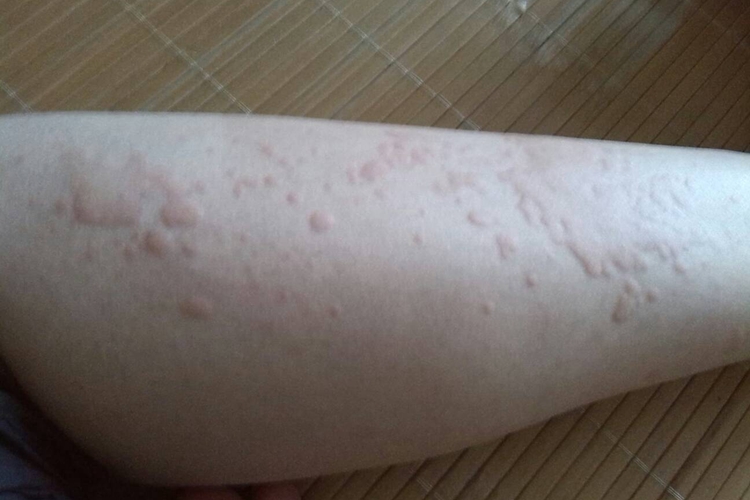 急性自发性荨麻疹腿红点图