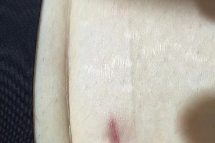 经腹腔镜手术瘢痕图