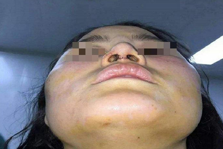 鼻中隔软骨移植术图