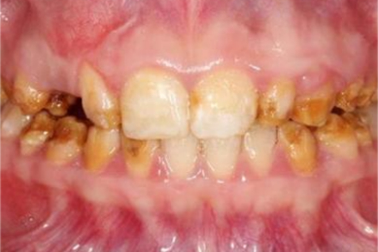 牙釉质发育不全牙齿症状图