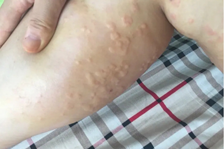 妊娠多形疹疙瘩图 妊娠多形疹疙瘩图