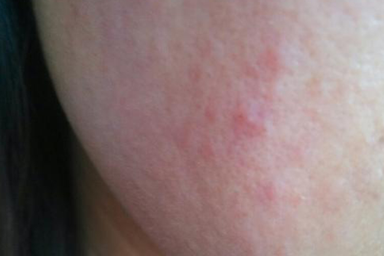 酒精过敏脸上起红疹图