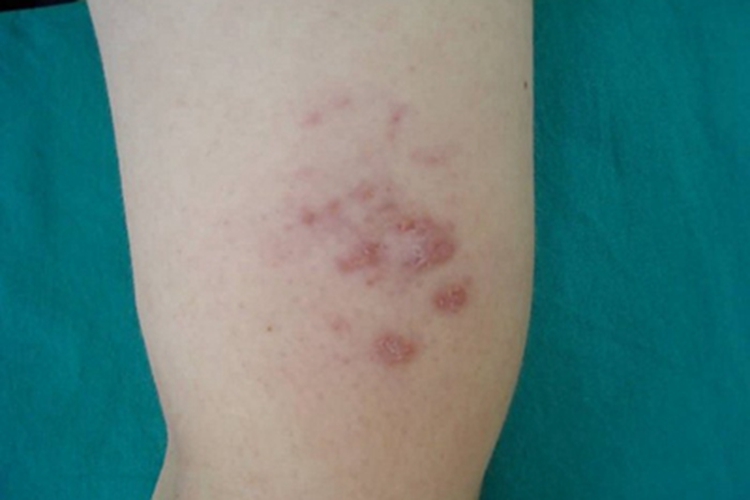 寻常狼疮初期图
