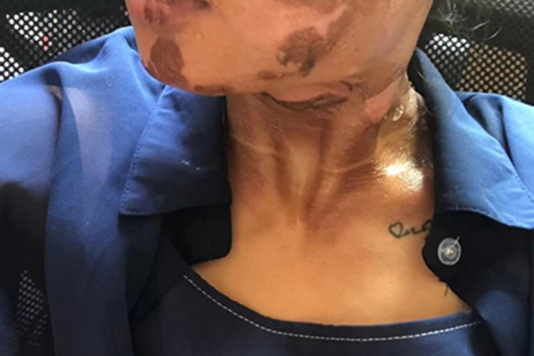 烫伤颈部红斑脱皮图 烫伤颈部红斑脱皮图