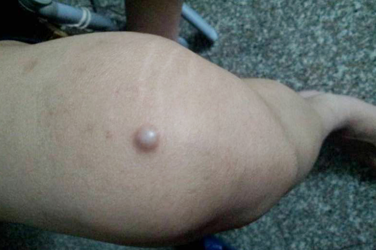 皮脂腺囊肿图 皮脂腺囊肿图