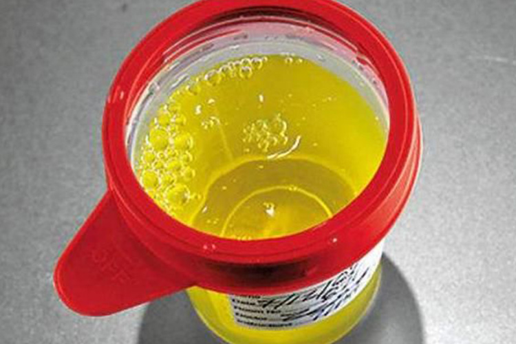 正常尿液泡沫图