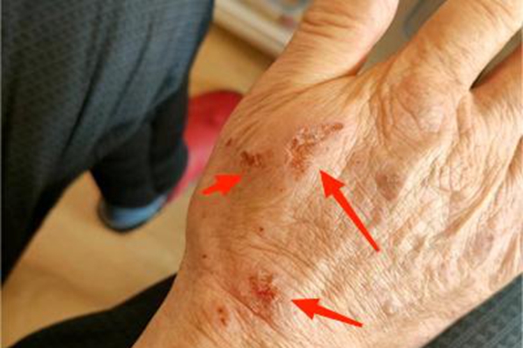 亚急性湿疹手背有几块结痂图