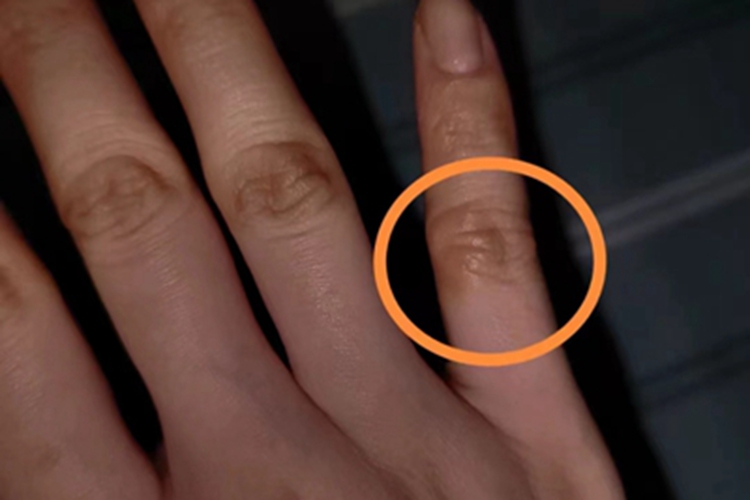 点状掌跖角化病手指颜色加深图