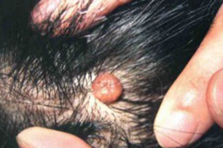 单发性有蒂软纤维瘤图 单发性有蒂软纤维瘤图