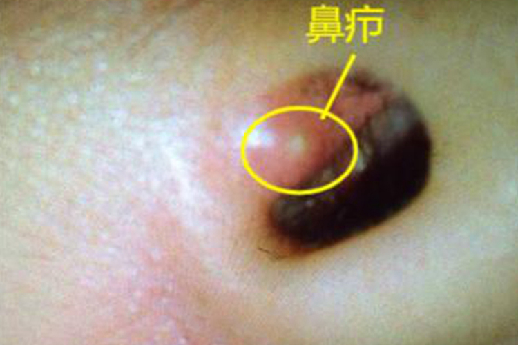 鼻疖图
