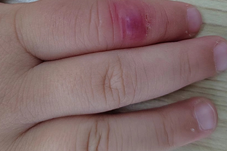 虫咬皮炎手指红肿图 虫咬皮炎手指红肿图
