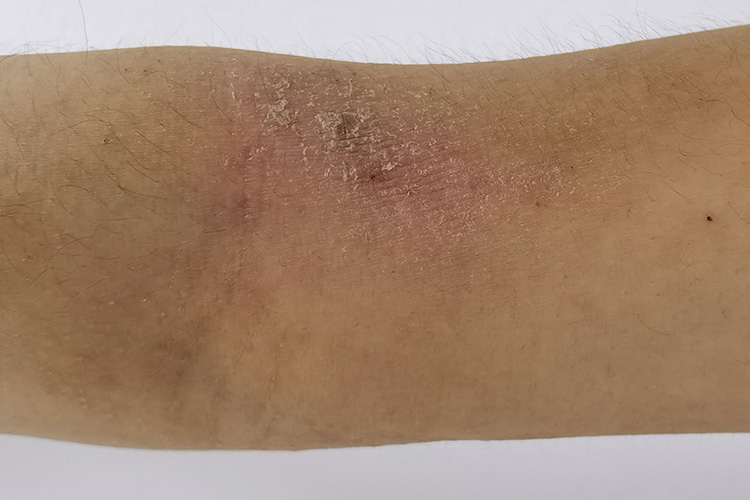 干性湿疹潮红图