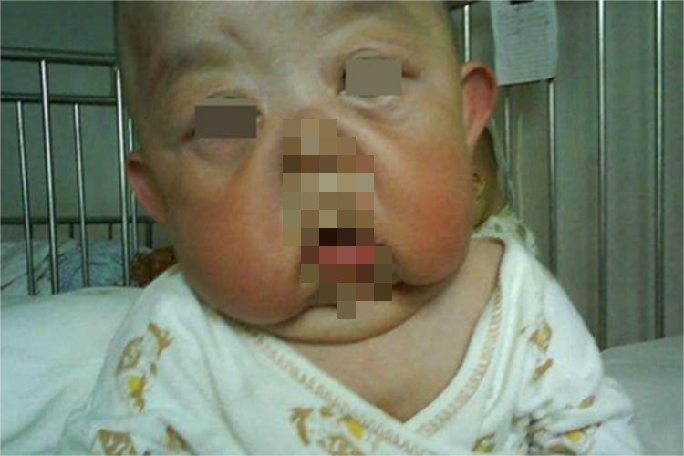 皮肤弹性过度面部松弛图