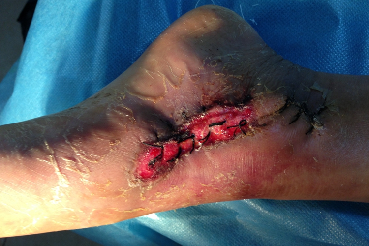 缝针后伤口发炎图