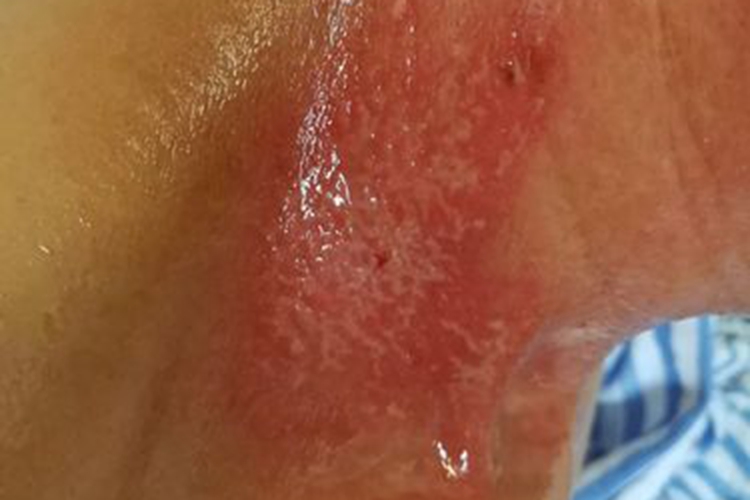 乳腺癌放疗腋窝湿性皮炎图