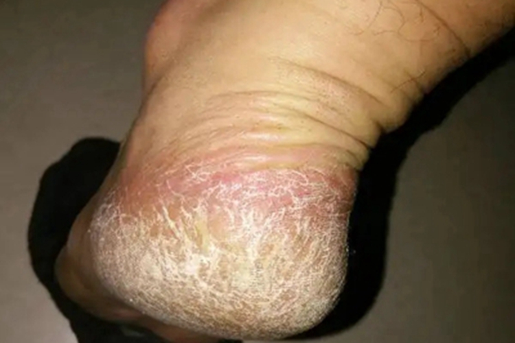 手足皲裂脚后跟症状图