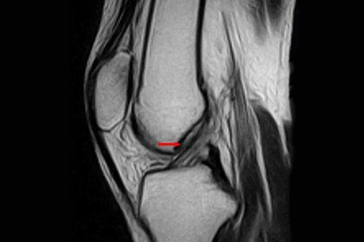 正常前交叉韧带MRI图
