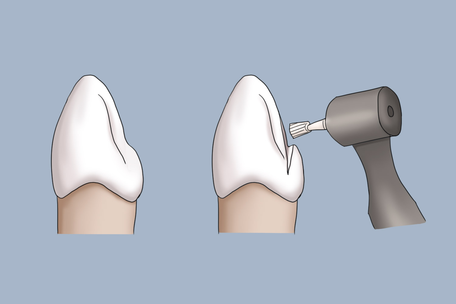 尖牙支托凹预备图