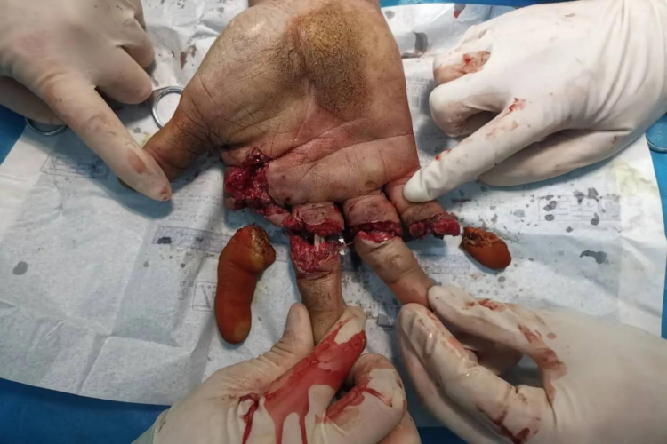 手指不完全性断离图