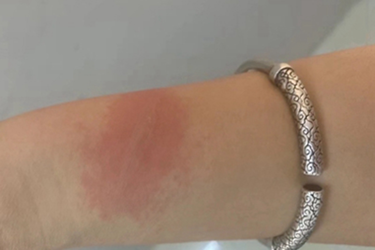 一度烫伤胳膊红斑图