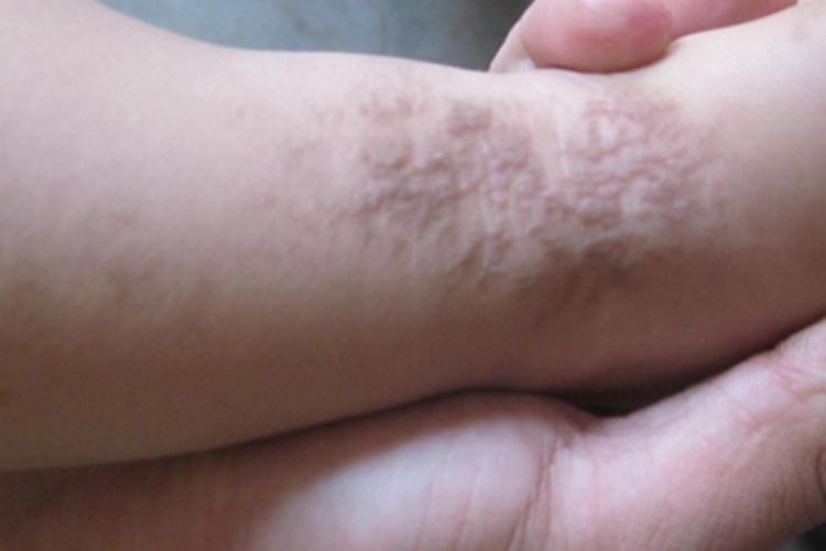 局限型表皮痣丘疹图 局限型表皮痣丘疹图