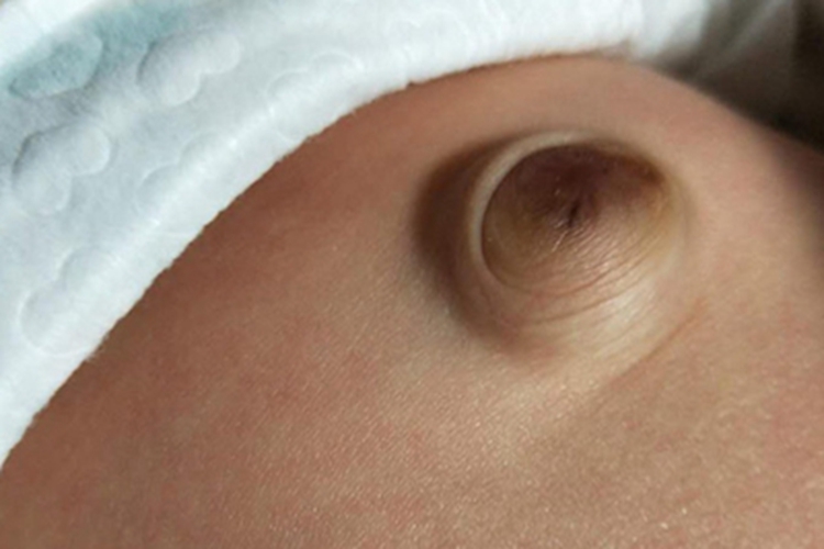 小儿脐疝肚脐凸出肿块图