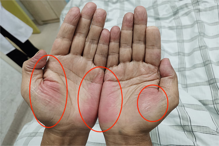 鹅肝掌的症状图片高清_有来医生