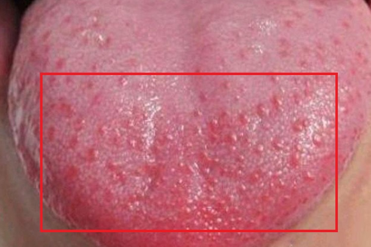 舌背部菌状乳头炎图 舌背部菌状乳头炎图