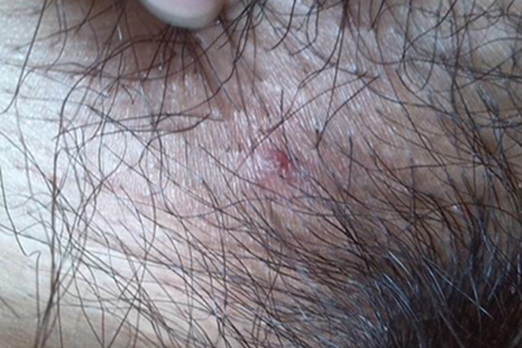外阴毛囊炎大疙瘩图 外阴毛囊炎大疙瘩图