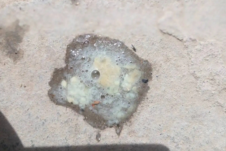 肺结核咳出坏死物图 肺结核咳出坏死物图