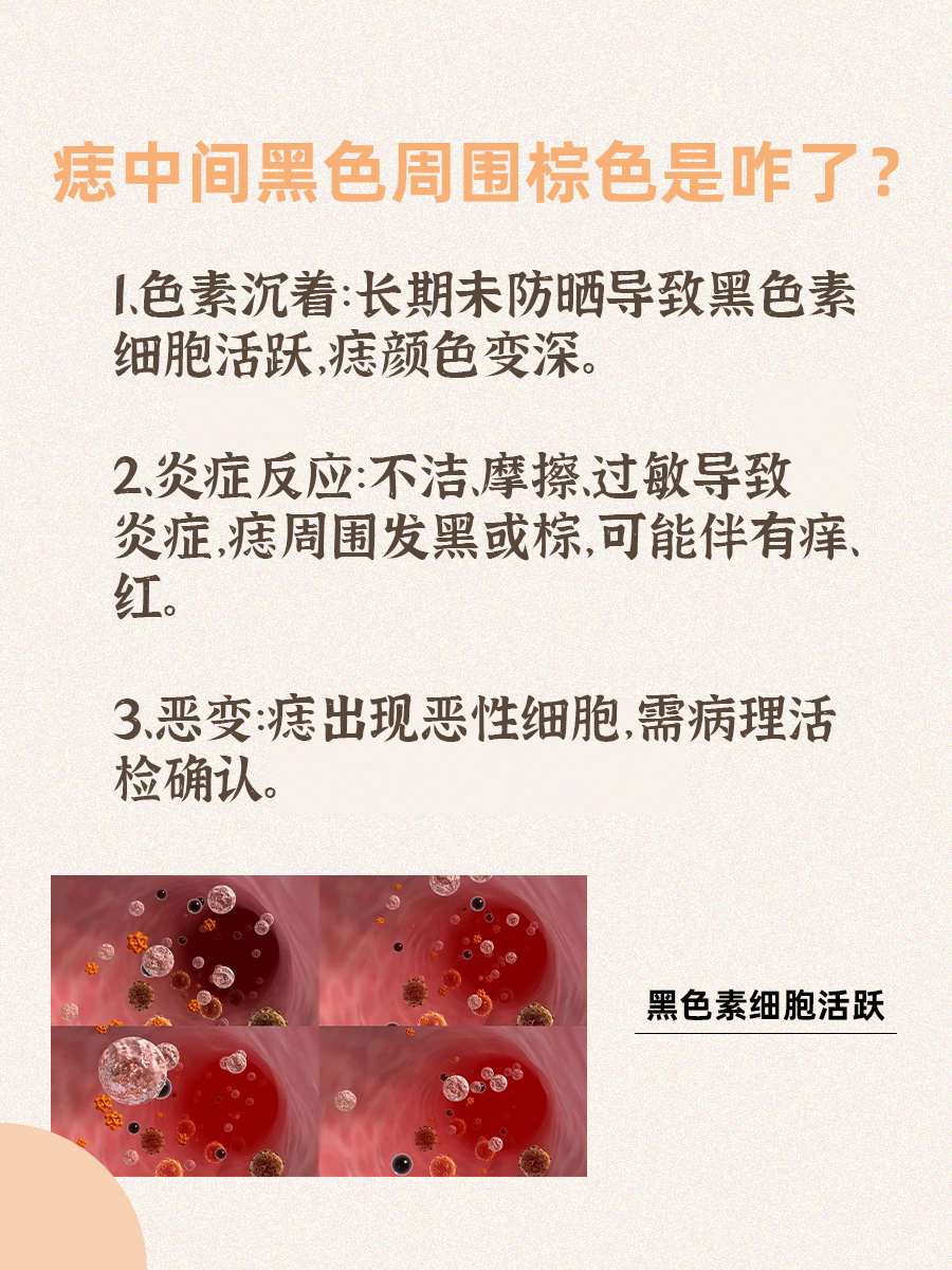 痣中间黑色周围棕色是咋了？一文帮你了解