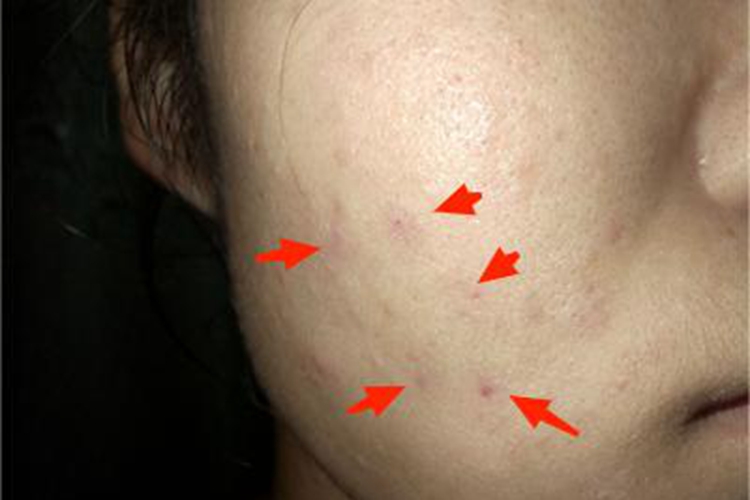 痤疮脸上有几个淡红色斑点图