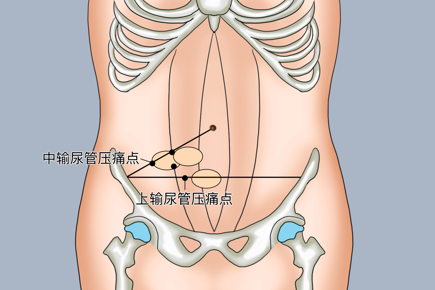 上、中输尿管压痛点