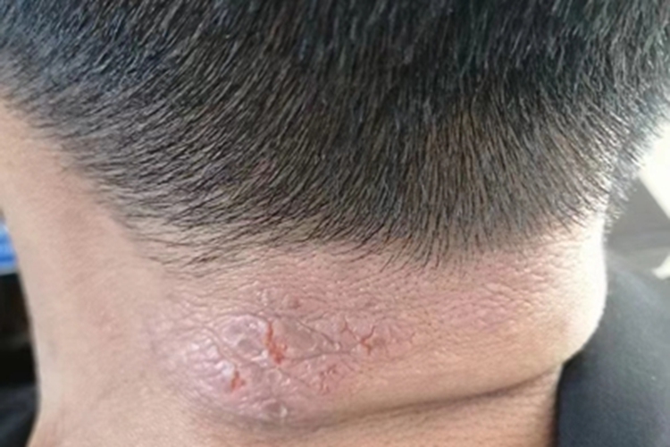 局限性神经性皮炎皮肤增厚图