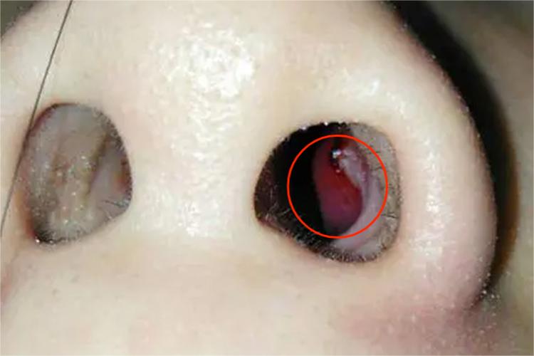 慢性化脓性鼻窦炎鼻窦肿大图