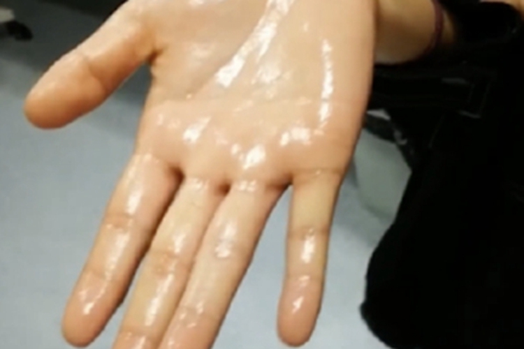 手汗症手部都是汗图 手汗症手部都是汗图
