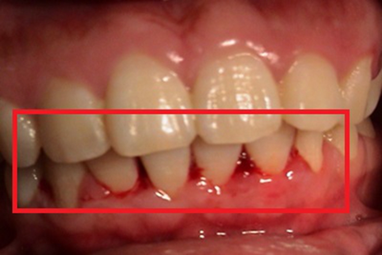 慢性苯中毒牙龈出血图