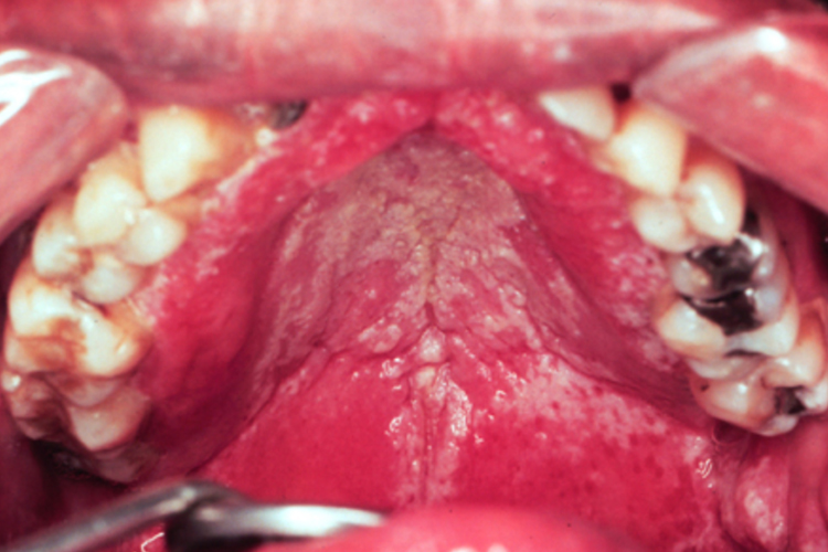 义齿性口炎图