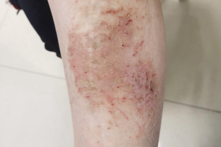 干性湿疹小腿红斑图