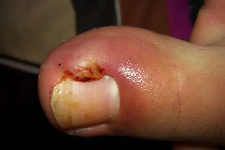 急性甲沟炎脚趾甲充血图 急性甲沟炎脚趾甲充血图