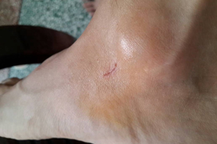 抓伤脚踝裂口图 抓伤脚踝裂口图