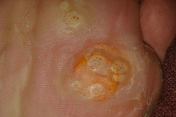 点状掌跖角化病脚底症状图 点状掌跖角化病脚底症状图