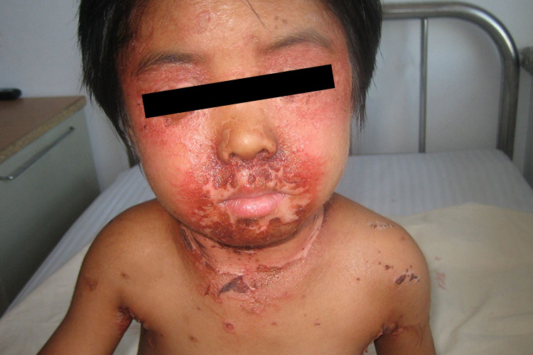 葡萄球菌性烫伤样皮肤综合征图