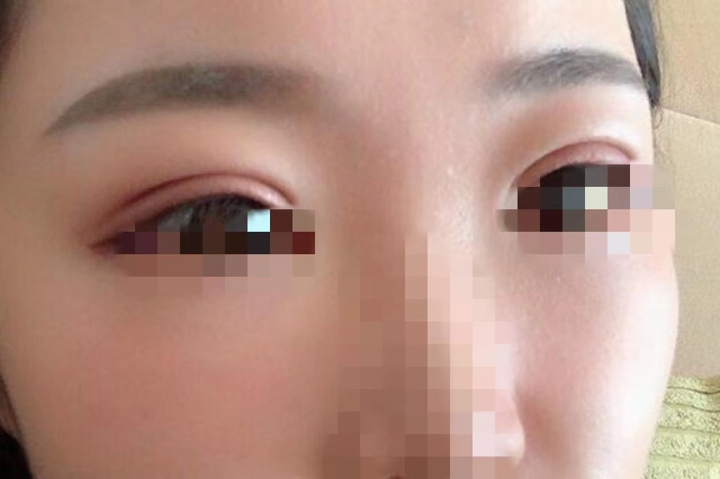 双眼皮埋线恢复七天轻微肿胀图 双眼皮埋线恢复七天轻微肿胀图