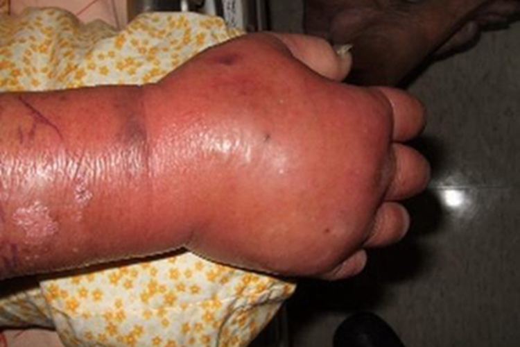 急性淋巴管炎手背红斑图