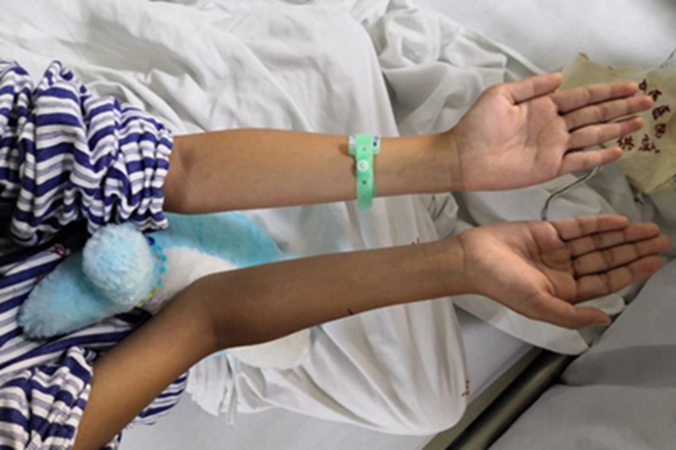 肘外翻超过20度的图