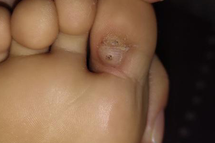 儿童脚上跖疣皮损图