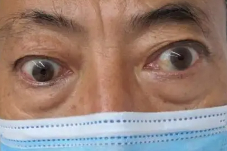 甲亢突眼图